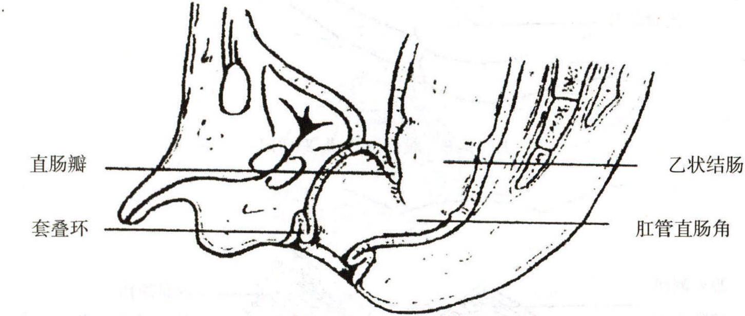 (三)會(huì)陰部結(jié)腸套疊肛管直腸重建術(shù)
